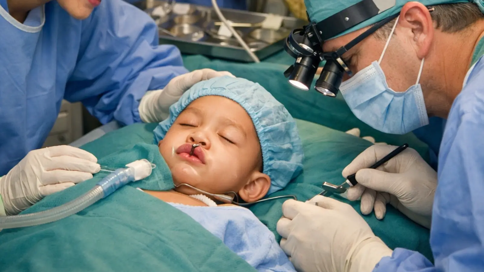 Mending Faces volunteer doctors providing free cleft lip and palate surgery to children